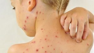 Dấu hiệu bệnh thủy đậu