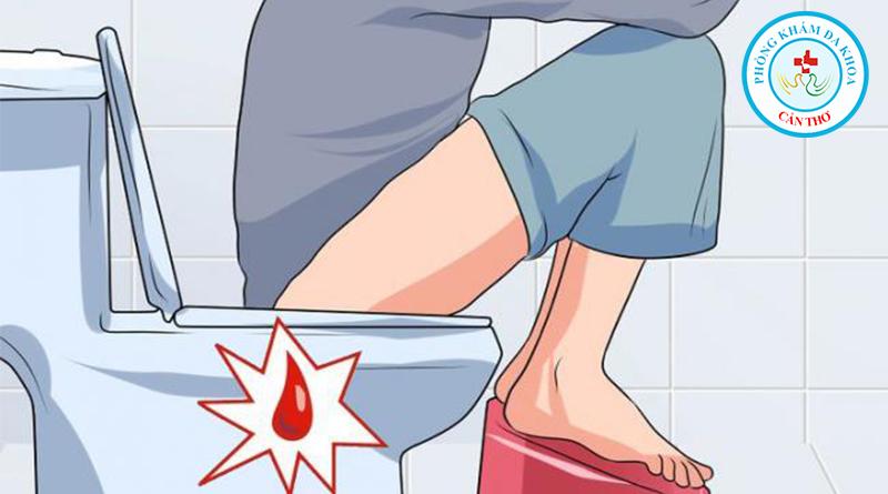 Cách điều trị chảy máu do bệnh trĩ | Bệnh ngoại khoa | Đa khoa Cần Thơ
