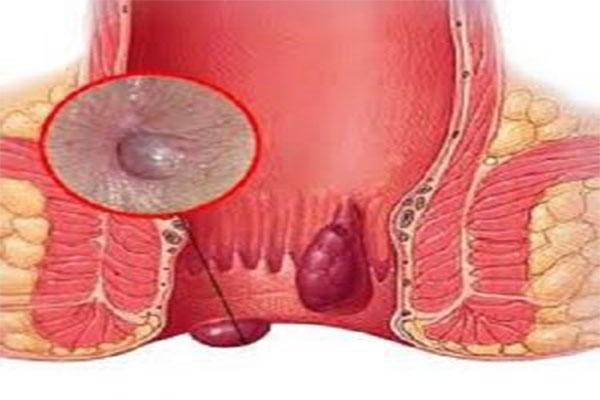 Hình ảnh bệnh trĩ ngoại