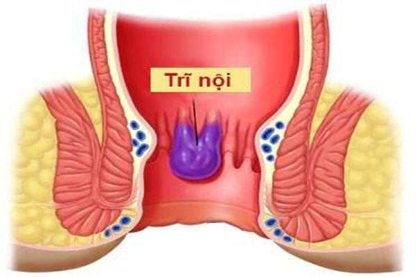 Hình ảnh trĩ nội