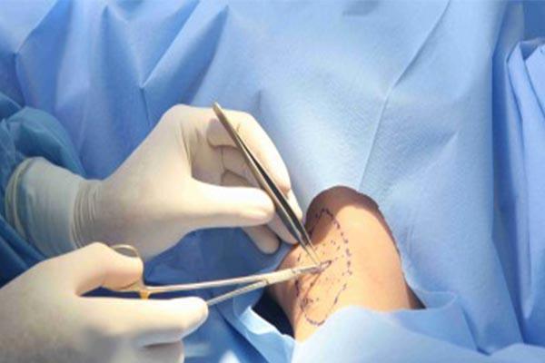 Phương pháp nội soi hút bỏ tuyến mồ hôi nách