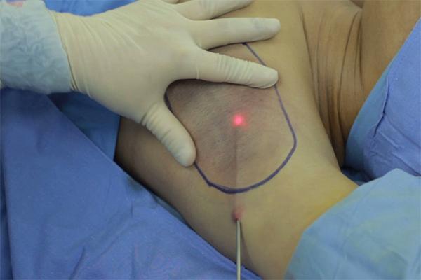 Phương pháp nội soi hút bỏ tuyến mồ hôi nách