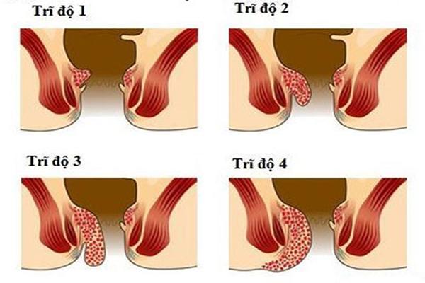 Trĩ nội chia làm 4 độ