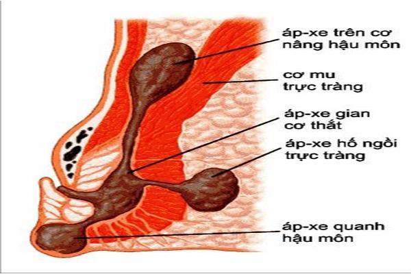Áp-xe hậu môn hình thành khối cứng