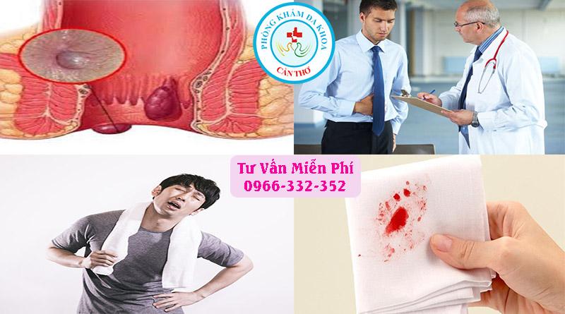 Các dấu hiệu nhận biết bệnh trĩ ngoại | Phòng khám đa khoa Gia Phước