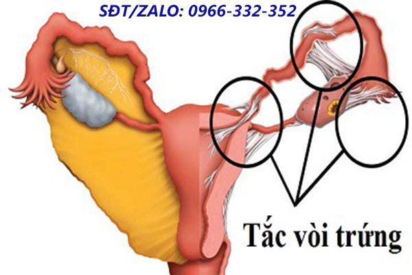 Vòi trứng bị tắc nghẽn