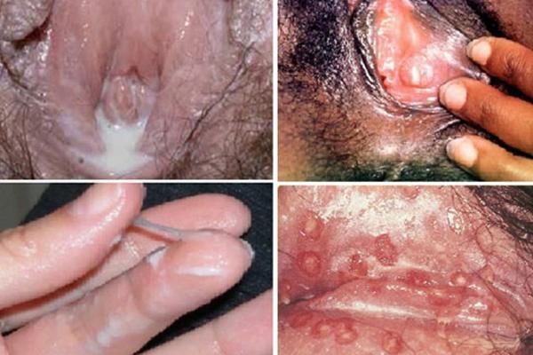 Bệnh lậu ở nữ giới