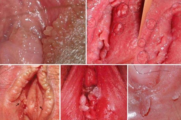 Biểu hiện sùi mào gà ở nữ giới