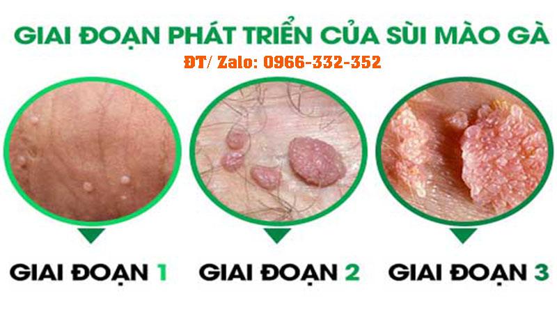 Hình ảnh về bệnh Sùi mào gà ở nam giới và nữ giới | Bệnh xã hội