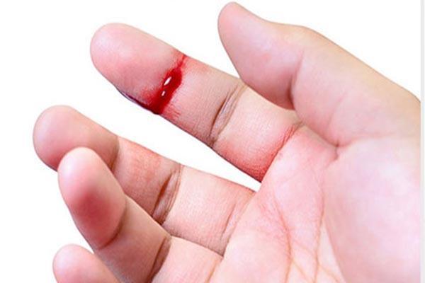 Lây nhiễm sùi mào gà do tiếp xúc vết thương hở