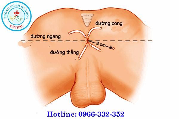 hình ảnh bệnh rò hậu môn