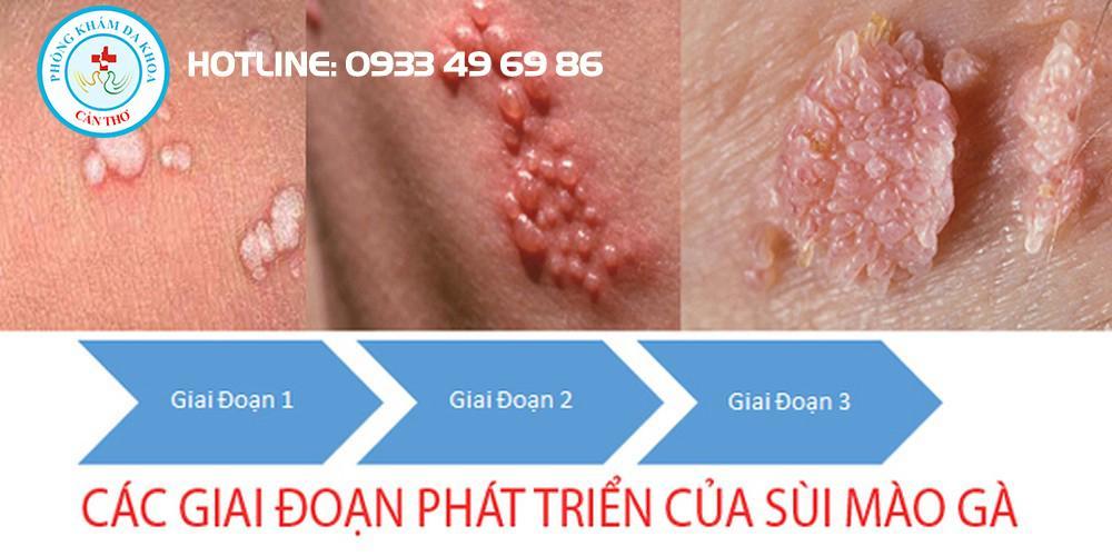 Các giai đoạn phát triển của sùi mào gà