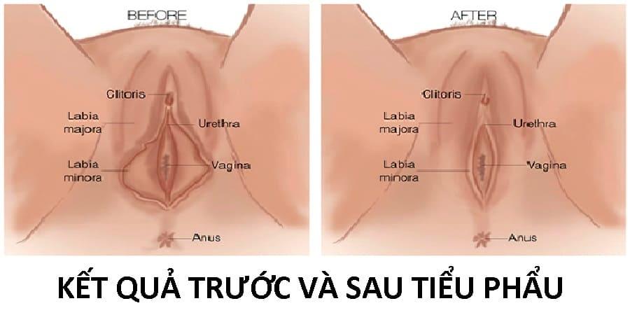 Thu hẹp âm đạo - May vá màng trinh thẩm mỹ an toàn tại Cần Thơ