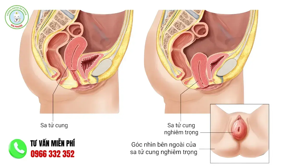 Hình ảnh sa tử cung