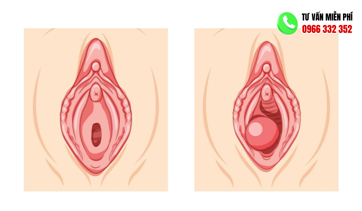  Hình Ảnh Nổi Mụn Ở Vùng Kín Nữ 
