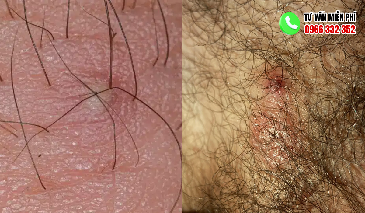hình ảnh nổi mụn ở vùng kín nam