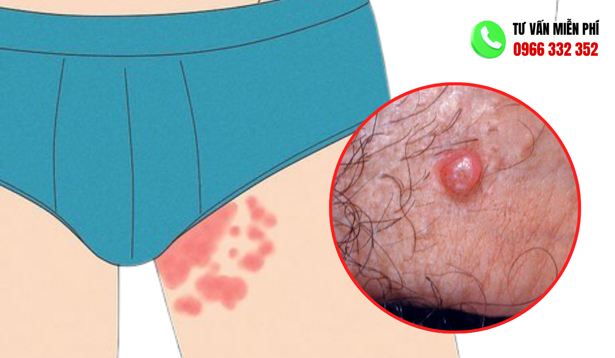 hình ảnh nổi mụn ở vùng kín nam