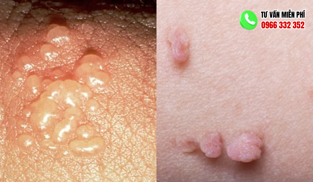  Hình Ảnh Nổi Mụn Ở Vùng Kín Nữ 