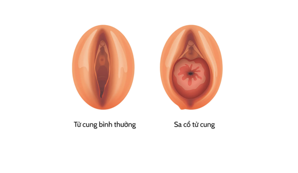 hình ảnh sa tử cung sau sinh