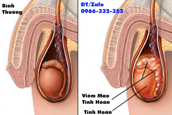 viêm mào tinh hoàn