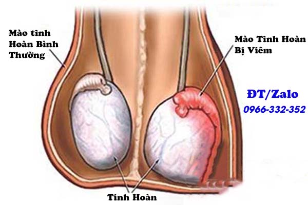 viêm mào tinh hoàn
