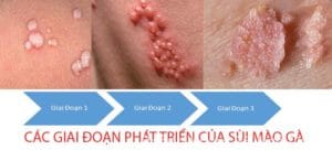 Cac giai doan phat trien cua sui mao ga