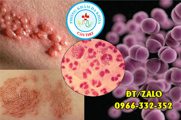 bệnh lậu ở nữ giới