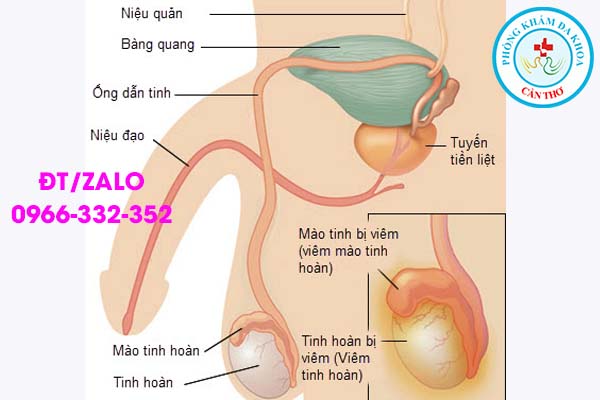 biến chứng của bệnh lậu ở nam giới