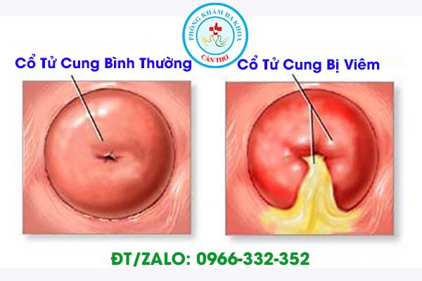 biến chứng của bệnh lậu đối với nữ giới