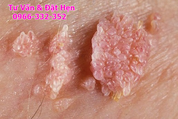 biểu hiện của sùi mào gà