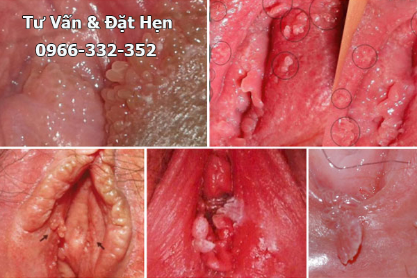 biểu hiện của sùi mào gà ở nữ