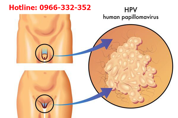 hình ảnh sùi mào gà ở nam giới