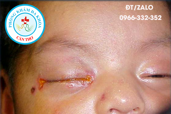 lây nhiễm cho trẻ sơ sinh