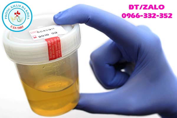 mẫu nước tiểu