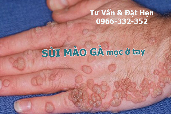 sùi mào gà mọc ở tay