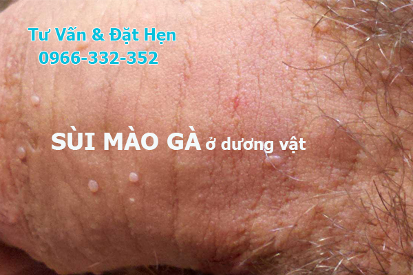 sùi mào gà ở dương vật