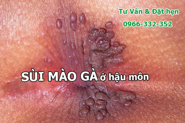 sùi mào gà mọc ở hậu môn