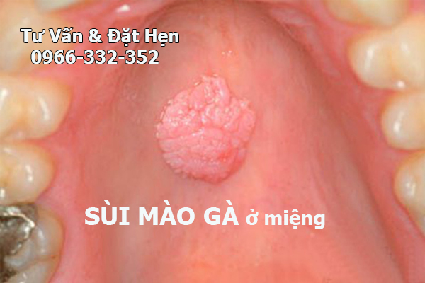 sùi mào gà ở miệng