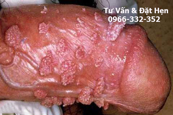 sùi mào gà ở nam