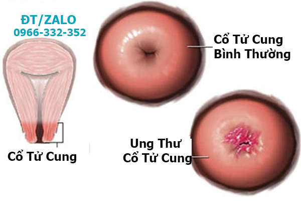 tác hại của sùi mào gà