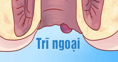 Cách chữa dứt điểm trĩ ngoại