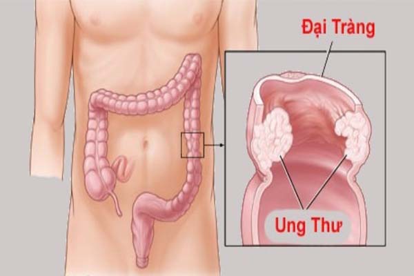 Hình ảnh ung thư đại tràng
