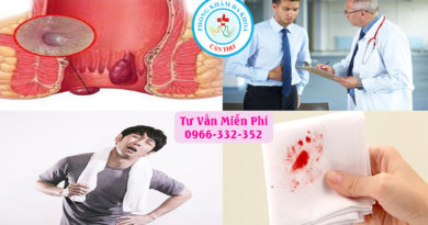 Các dấu hiệu nhận biết bệnh trĩ ngoại