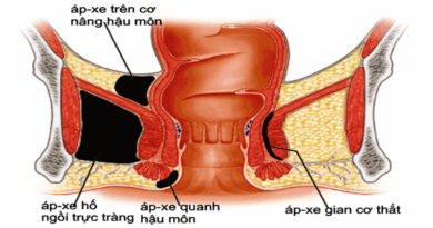 Hình ảnh áp-xe hậu môn
