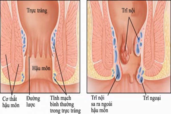 Phân biệt bệnh trĩ và ung thư trực tràng