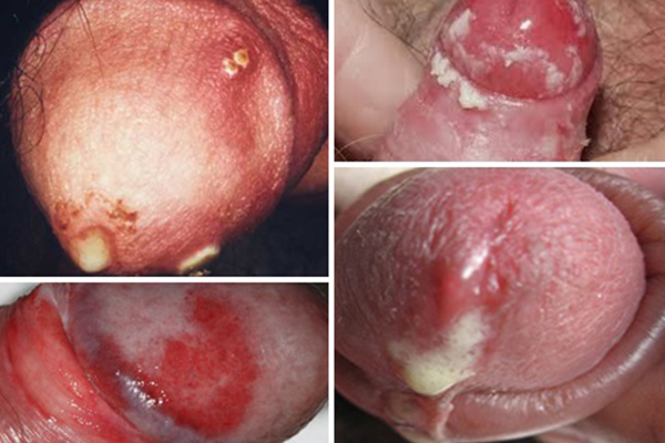 Bệnh lậu ở nam giới