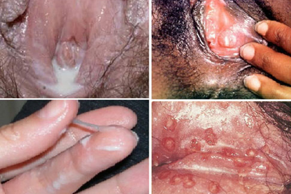 Bệnh lậu ở nữ giới