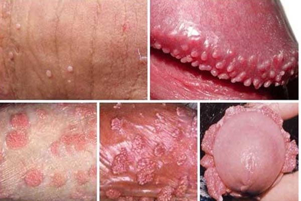 Biểu hiện sùi mào gà ở nam giới