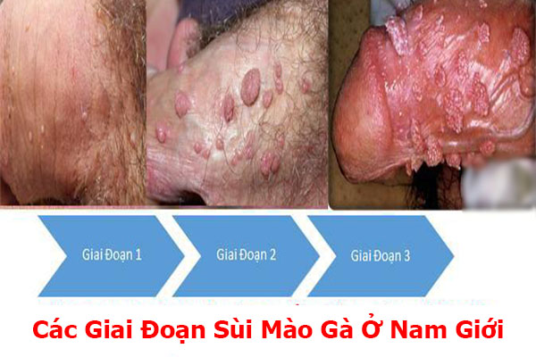 Hình ảnh sùi mào gà ở dương vật nam giới