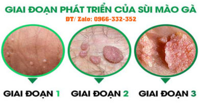 Hình ảnh sùi mào gà